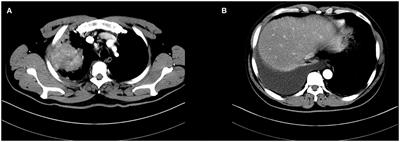 Targeted Therapy Followed by Salvage Surgery and Adjuvant Therapy: A Promising Therapy for Lung Cancer With Malignant Pleural Effusion From a Case Report